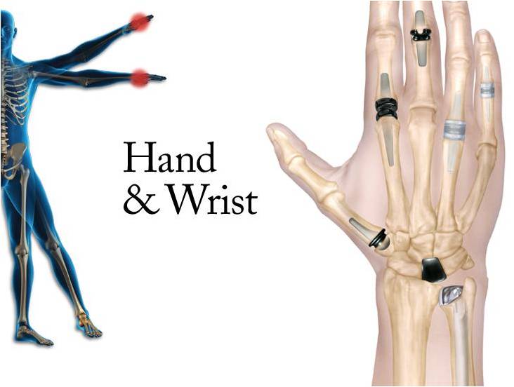 Small Joint Replacements in the Hand